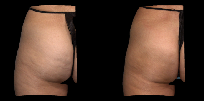 3D color view. Left side.