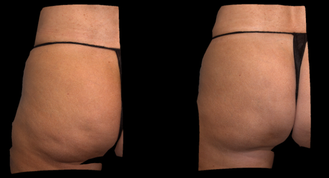 3D color view. Left side.