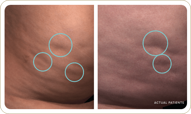 Adult woman’s buttock with arrows pointing to variations of acceptable laxity