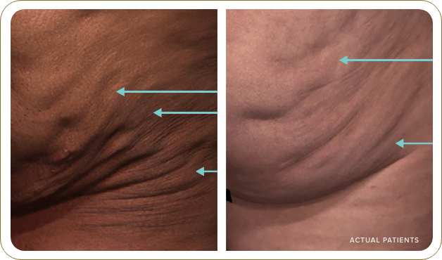 Adult woman’s buttock with arrows pointing to variations of acceptable laxity
